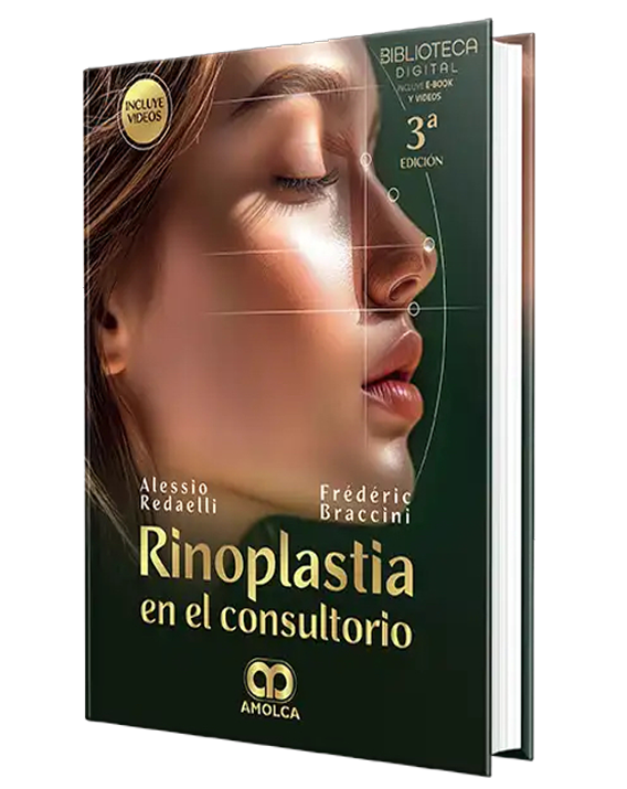 Rinoplastia en el consultorio - Spanish Edition